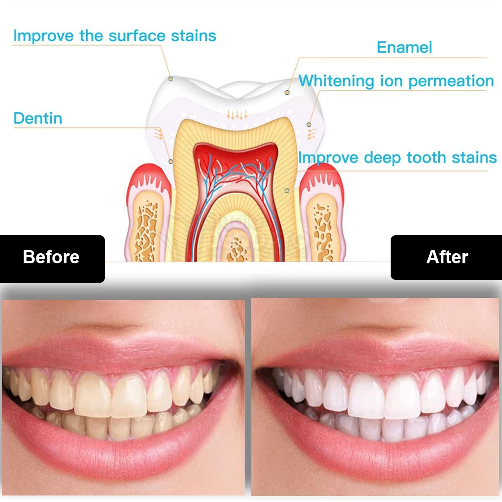 Teeth Whitening Kit